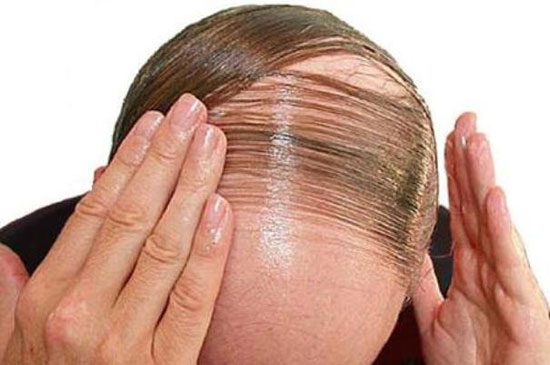 رفع ریزش مو به کمک سلول های بنیادی