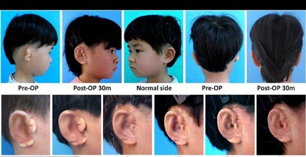 محققان چینی برای ۵ کودک گوش ساختند