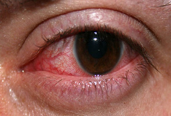 نشانه‌های سرطان چشم چیست؟