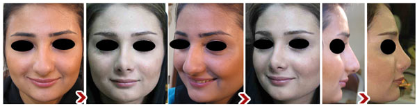 جراحی زیبایی بینی، پلک، گونه، چانه، گوش و صورت با دکتر سوران ایوبیان