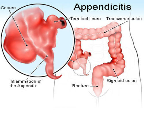 آپاندیسیت، دردی که نباید سرسری گرفت