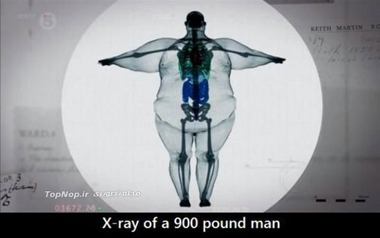چاق ترین مرد دنیا زیر اشعه ایکس +عکس