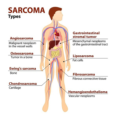 «سارکوما» یا «چنگار گوشتی»، سرطان ناشناخته