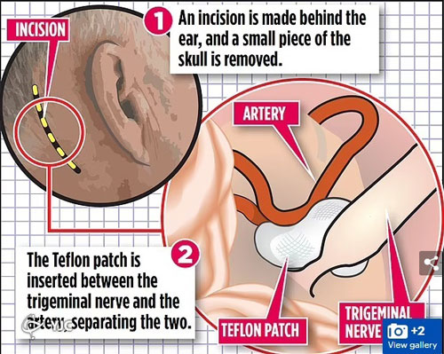 درمان سردرد با کاشت تفلون در مغز