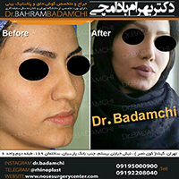 جراحی مدرن بینی توسط دکتر بهرام بادامچی