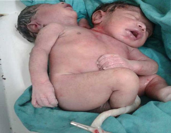 به دنیا آمدن نوزادی دو سر و دارای سه دست در کشور هند