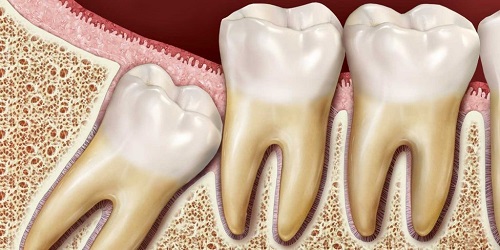 جراحی دندان عقل و هزینه آن