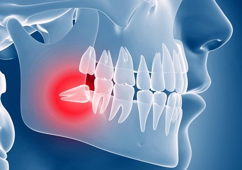 جراحی دندان عقل نهفته | هزینه  و مراقبت های  بعد از جراحی