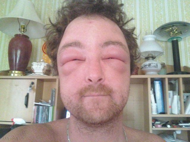 عاقبت دردناک آلرژی به نیش زنبور +عکس