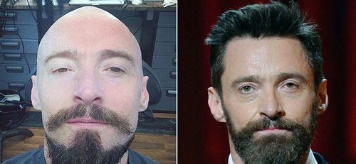 هیو جکمن برای سومین بار تحت درمان سرطان هیو جکمن برای سومین بار تحت درمان سرطان