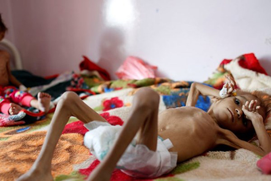 دختر بچه یمنی بالاخره از گرسنگی جان باخت