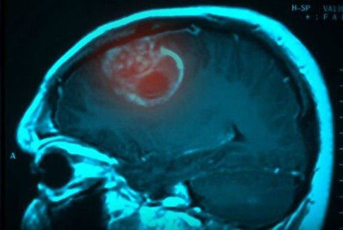 کشف علت اصلی ابتلا به سرطان مغز