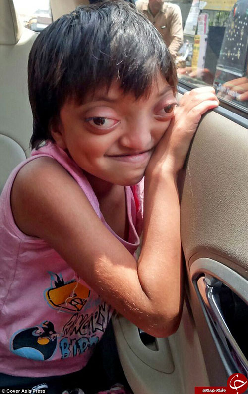 بیماری نادر یک دختر بچه +عکس