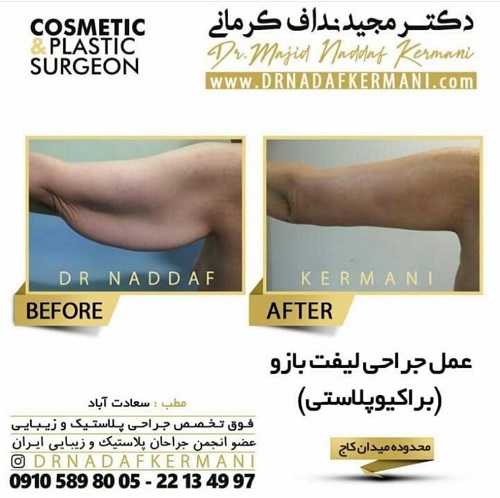 عمل لیفت بازو یا براکیوپلاستی چیست؟ + هزینه