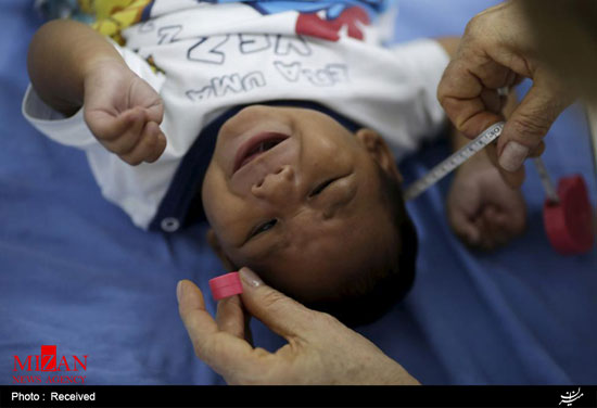 نوزادان مبتلا به ویروس زیکا +عکس
