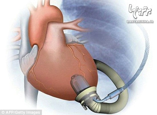 کوچک ترین قلب مصنوعی ساخته شد