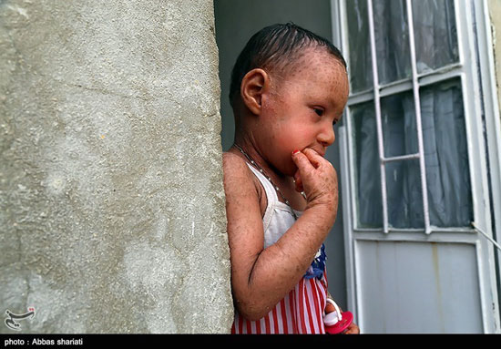 عکس: بیماری دردناک ملیکا کوچولو