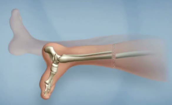 جراحی چرخش پا یا روتیشن پلاستی