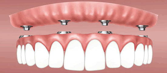 دندان مصنوعی ثابت چیست و قیمت آن چقدر است؟