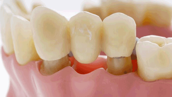 بریج دندان چیست؟ مزایا و قیمت آن