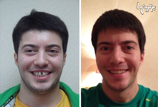 تصاویر باورنکردنی از قبل و بعد از ارتودنسی