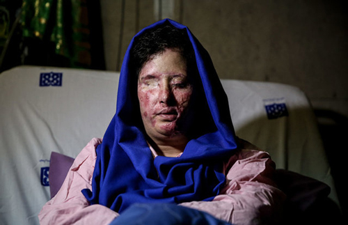 گفتگو با قربانی فراموش شده اسیدپاشی در اصفهان