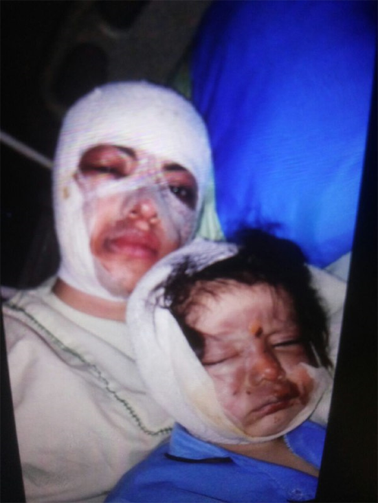 اسیدپاشی روی صورت عمه و برادرزاده اش (۱۶+)