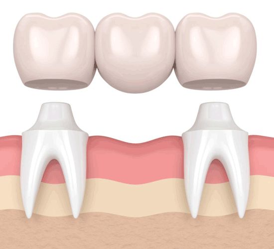 بریج دندان چیست؟ مزایا و قیمت آن