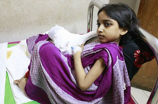 دختر بنگلادشی ۱۲ ساله‌ با بیماری نادر «مرد درختی»