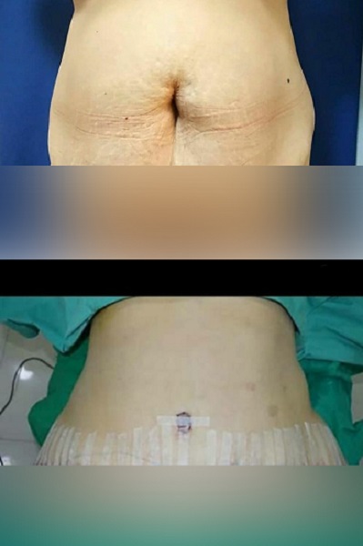 جراحی زیبایی شکم (عمل ابدومینوپلاستی) | مزایا، عوارض و هزینه 