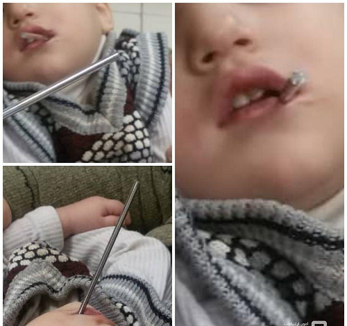فرو رفتن میله در دهان کودک ۲ ساله